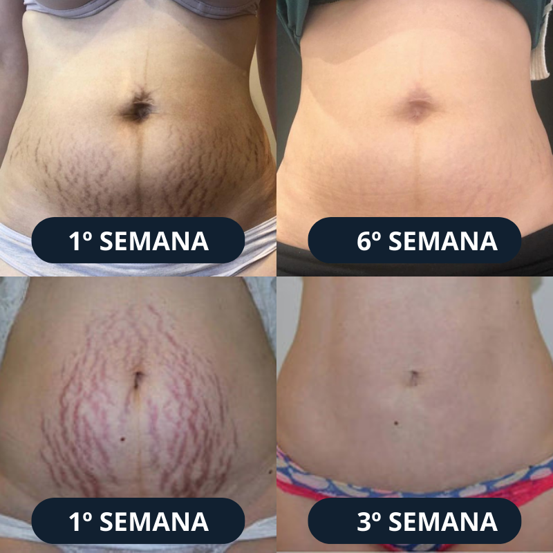 DermaSkin™ Adesivo de Colágeno - Volte a ter uma Pele Linda e Livre de Imperfeições